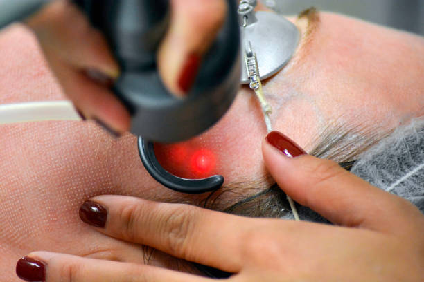 Fraktionerad CO2-laser ärrbehandling och hudföryngring på klinik i Järfälla Barkarbystaden