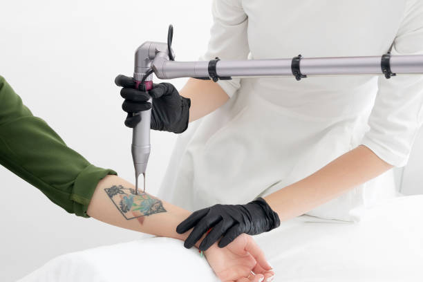 Tatueringsborttagning med laser och Phiremoval teknik på kliniken i Järfälla